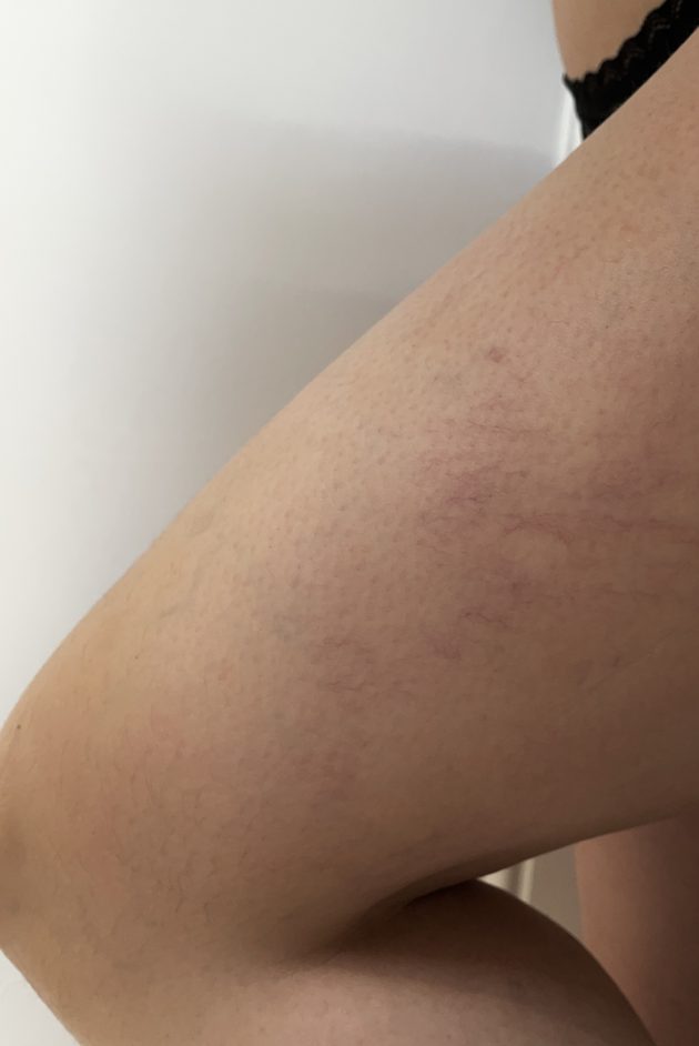 Microsclerotherapy Spider Vein Treatment Woking | BodyLab Aesthetics